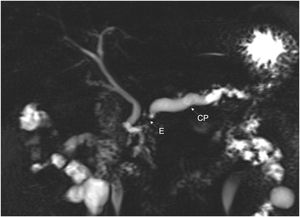 Estudio de resonancia magnética que evidencia dilatación importante del conducto pancreático principal (CP), asociado a estenosis (E) del mismo a nivel de la cabeza. Paciente inicialmente manejado por endoscopia.