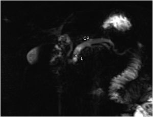 Estudio de resonancia magnética que evidencia dilatación importante del conducto pancreático principal (CP) y de ramas laterales, asociado a lito intraductal (L). Paciente inicialmente manejado por endoscopia.