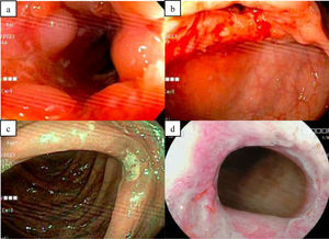 a: íleon con úlceras b: válvula íleo cecal ulcerada c: úlcera en colon transverso d: canal anal ulcerado. Esta figura compuesta es original de nuestra propia autoría.