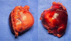 Pieza quirúrgica obtenida en vista anterior y posterior, quiste de duplicación pancreático. Fuente: imágenes de nuestra autoría.