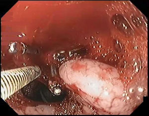 Úlcera duodenal Forrest Ia con hemorragia activa en capa luego de doble terapia hemostática endoscópica fallida con hemoclips y adrenalina.