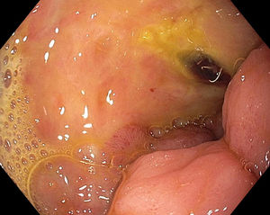 Espiral endovascular protruyendo de la mucosa en sitio de vaso visible en el lecho de la úlcera con fibrina.