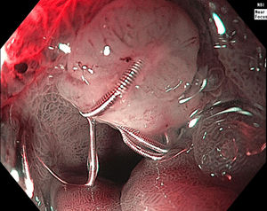 Espiral endovascular protruyendo de la mucosa duodenal en el sitio de la úlcera péptica 4meses posteriores al evento índice (imagen de banda estrecha con magnificación).