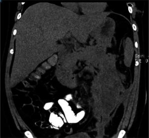 Tomografía computarizada contrastada. Se observa necrosis pancreática y colecciones en la corredera parietocólica.