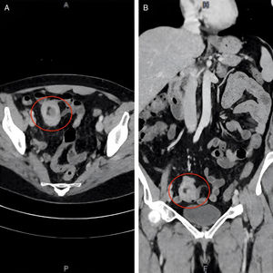 A). Tomografía de abdomen: Corte axial se observa oclusión intestinal con imagen de intususcepción a nivel de íleon terminal y un pólipo en su interior (círculo rojo), 1 B): Corte coronal se observa en corte coronal la zona de oclusión intestinal (círculo rojo). A). Tomografía de abdomen: Corte axial se observa oclusión intestinal con imagen de intususcepción a nivel de íleon terminal y un pólipo en su interior (círculo rojo), 1 B): Corte coronal se observa en corte coronal la zona de oclusión intestinal (círculo rojo).