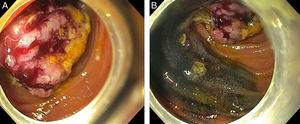 A). Enteroscopia de monobalón: Se observa tumoración que abarca el 80% de la luz intestinal, friable y con sangrado, 2 B): zona de íleon con marcaje con tinta china anterior a la tumoración. A). Enteroscopia de monobalón: Se observa tumoración que abarca el 80% de la luz intestinal, friable y con sangrado, 2 B): zona de íleon con marcaje con tinta china anterior a la tumoración.