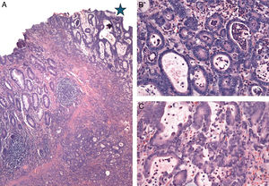 Patología: Adenocarcinoma moderadamente diferenciado de intestino delgado. 3A) Panorámica donde se identifica mucosa intestinal con inflamación (izquierda) y la transición a adenocarcinoma (derecha / asterisco). Hematoxilina y Eosina x200. 3B) y 3C) Glándulas neoplásicas de adenocarcinoma, con alteración en la arquitectura y atipia citológica e inflamación aguda y crónica acentuada. Hematoxilina y Eosina x400. Patología: Adenocarcinoma moderadamente diferenciado de intestino delgado. 3A) Panorámica donde se identifica mucosa intestinal con inflamación (izquierda) y la transición a adenocarcinoma (derecha / asterisco). Hematoxilina y Eosina x200. 3B) y 3C) Glándulas neoplásicas de adenocarcinoma, con alteración en la arquitectura y atipia citológica e inflamación aguda y crónica acentuada. Hematoxilina y Eosina x400.