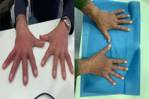 Eritromelalgia en ambas manos (izquierda). Resolución de la eritromelalgia tras cirugía (derecha). Eritromelalgia en ambas manos (izquierda). Resolución de la eritromelalgia tras cirugía (derecha).