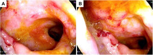 A y B. Muestra la mucosa rectal de aspecto edematoso con pérdida del patrón vascular, erosiones superficiales y úlceras.