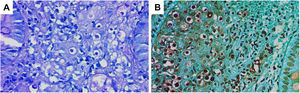A. Microfotografía con tinción de hematoxilina y eosina que muestra numerosas levaduras redondeadas con halo claro periférico, compatibles con Cryptococcus spp., distribuidas en el tejido rectal. Se identifica gemación estrecha característica y un fondo escasamente inflamatorio. B. Tinción de Grocott-Gomori con plata metenamina que resalta múltiples levaduras fúngicas teñidas de negro, con gemación estrecha, confirmando la presencia de Cryptococcus spp. en el tejido rectal.