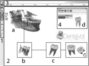 Interfaces de DentaVol©. 1: barra de herramientas; 2: área de visualización; 3: filtro de escala de grises; y 4: área de estudio de un caso); y secuencia del procesado de las imágenes (a: visualización de las imágenes en 3D; b: selección del área de estudio; c: aislamiento del tercer molar; y d: medidas de volúmenes). Tomado de Márquez et al.20.