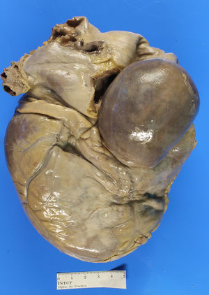 Formación nodular de 6 x 5 x 3 cm en relación con la arteria coronaria derecha (CD).