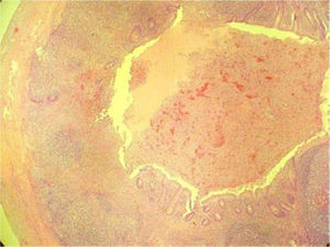 Tinción H-E, aumento 10×. Se observa la luz apendicular (borde superior derecho) y la mucosa y la pared muscular con extenso infiltrado polimorfo nuclear neutrófilo. En la submucosa se observan 4 folículos linfoides característicos del tejido apendicular.