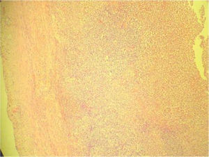 Tinción H-E, aumento 40×. Se observan las capas muscular (borde izquierdo), submucosa y mucosa (tercio medio) con extenso e intenso infiltrado de polimorfo nuclear neutrófilo.