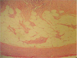 Tinción H-E, aumento 10×. Se aprecian las capas histológicas de la foto anterior, claramente identificándose adipocitos y fibras colágenas que reemplazan la mucosa y la submucosa, lo que establece el diagnóstico de involución fibroadiposa de apéndice cecal.