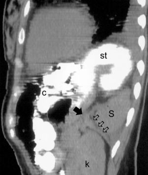 TC preoperatorio: estomago, intestino y epiplón herniados a través de un defecto en el diafragma y alojados en el hemitórax izquierdo. La flecha negra indica el tabique de diafragma roto. c: colon; k: riñón; S: bazo; st: estómago.