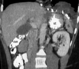 Tomografía de control postoperatoria: no herniación en el hemitórax izquierdo. k: riñón; S: bazo; st: estómago.