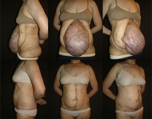Caso n.o 1: Fotografías preoperatorias (arriba) y 10 meses postoperatorias (abajo).