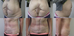 Caso n.o 2: Fotografías preoperatorias (arriba) y 12 meses postoperatorias (abajo).