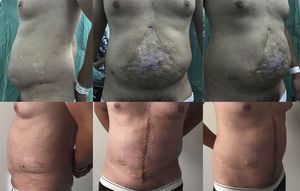 Caso n.o 3: Fotografías preoperatorias (arriba) y 3 semanas postoperatorias (abajo).