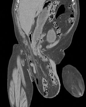 TC muestra hernia inguinal derecha de gran tamaño, con inclusión parcial de antro gástrico, colon transverso y asas de intestino delgado.