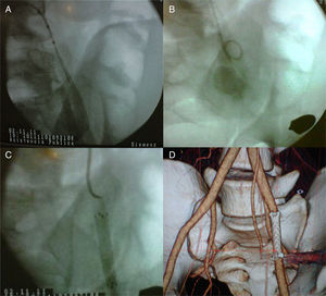 A) Fistula arteriovenosa de vasos ilíacos. B) Seudoaneurisma. C) Colocación de endoprótesis. D) Control con angioTAC 3D.