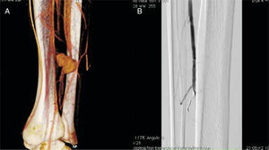 A) Seudoaneurisma de arteria peronea en angioTAC 3D. B) Angiografía que revela oclusión de seudoaneurisma con coil y trombosis de peronea distal.