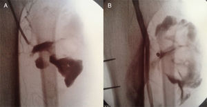 A) Seudoaneurisma de arteria tibial anterior proximal en angiografía. B) Oclusión de seudoaneurisma con coils.