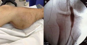 A) Seudoaneurisma gigante de arteria poplítea. B) Implante de endoprótesis o stent graft.