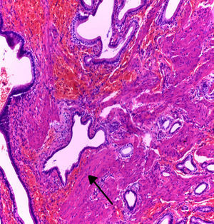 Microfotografía de adenomiomatosis en vesícula biliar (flecha). Tinción hematoxilina eosina, 10X.
