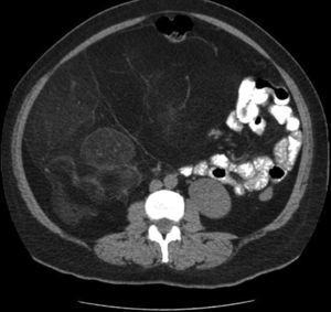 Corte axial de TAC donde se observa dimensión del liposarcoma.