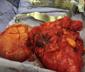 Liposarcoma resecado.
