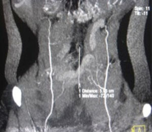 Mapeo con angio-TAC de los vasos perforantes principales del abdomen. Se evalúa su posición en relación con el ombligo.