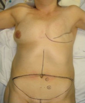 Marcación preoperatoria del colgajo abdominal y los vasos perforantes predominantes confirmados por doppler.