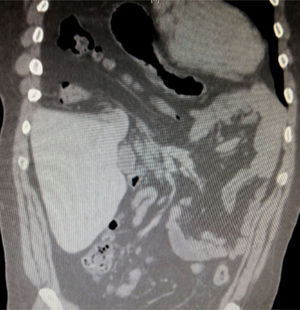 Tomografía axial computada. Víscera hueva en hemitórax derecho.