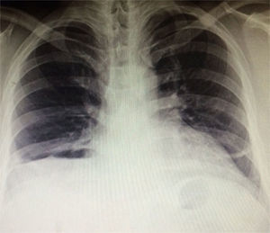 Telerradiografía de tórax postoperatoria.