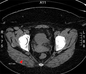 Ejemplo de tomografía computarizada a nivel del músculo glúteo en una mujer con obesidad. Se puede observar la infiltración grasa en el glúteo mayor (flecha).