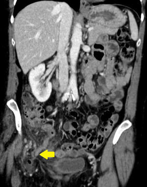 Corte coronal de tomografía axial computarizada, donde se aprecia apéndice cecal contenido en hernia crural (flecha).