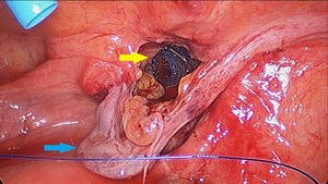 Tapón de malla ULTRAPRO® posicionado en orificio crural (flecha negra). Flap de peritoneo y saco herniario reducido (flecha blanca).