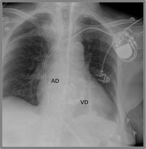 Radiografía de tórax de un marcapasos bicameral. Se observa electrodo en aurícula derecha (AD) y en ventrículo derecho (VD).