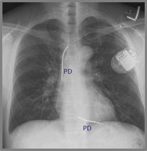 Radiografía de tórax de un cardiovertor-desfibrilador implantable unicameral, con ambas paletas desfibriladoras (PD) ubicadas a lo largo del electrodo del ventrículo derecho.