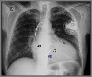 Radiografía de tórax de un marcapasos biventricular (terapia de resincronización cardíaca). Se observa un electrodo en la aurícula derecha (AD), en el seno coronario (SC) y en el ventrículo derecho (VD), con segmentos radioopacos a lo largo del electrodo del ventrículo derecho, que corresponden a las paletas desfibriladoras (PD).