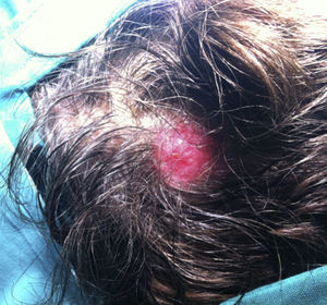 Placa alopécica eritematosa, localizada en cuero cabelludo.