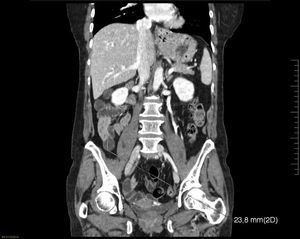 Tomografía computarizada abdominal con contraste intravenoso con reconstrucción coronal donde se observan las asas del intestino delgado no dilatadas situadas a la derecha del abdomen (con diámetro de 23,8mm).