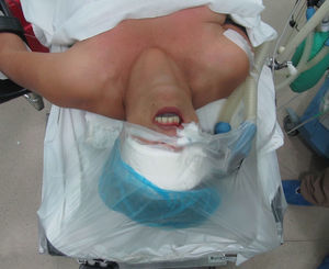 La paciente se coloca en decúbito dorsal con el cuello en hiperextensión, con intubación nasotraqueal y cubierta de plástico estéril desde el labio superior.