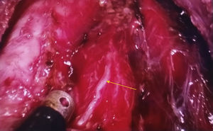 Identificación del nervio laríngeo recurrente (flecha).