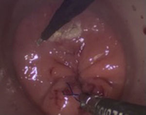 Realización de jareta en la mucosa rectal.