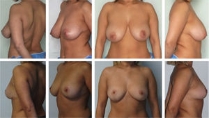 Paciente sometida a cirugía de reducción mamaria.