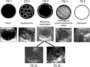 Características de las imágenes ecográficas y clasificación de la OMS de las etapas evolutivas. Fuente: WHO Informal Group on Echinococcosis1.