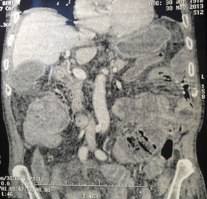 Corte frontal que muestra la imagen en seudoriñón de la intususcepción.